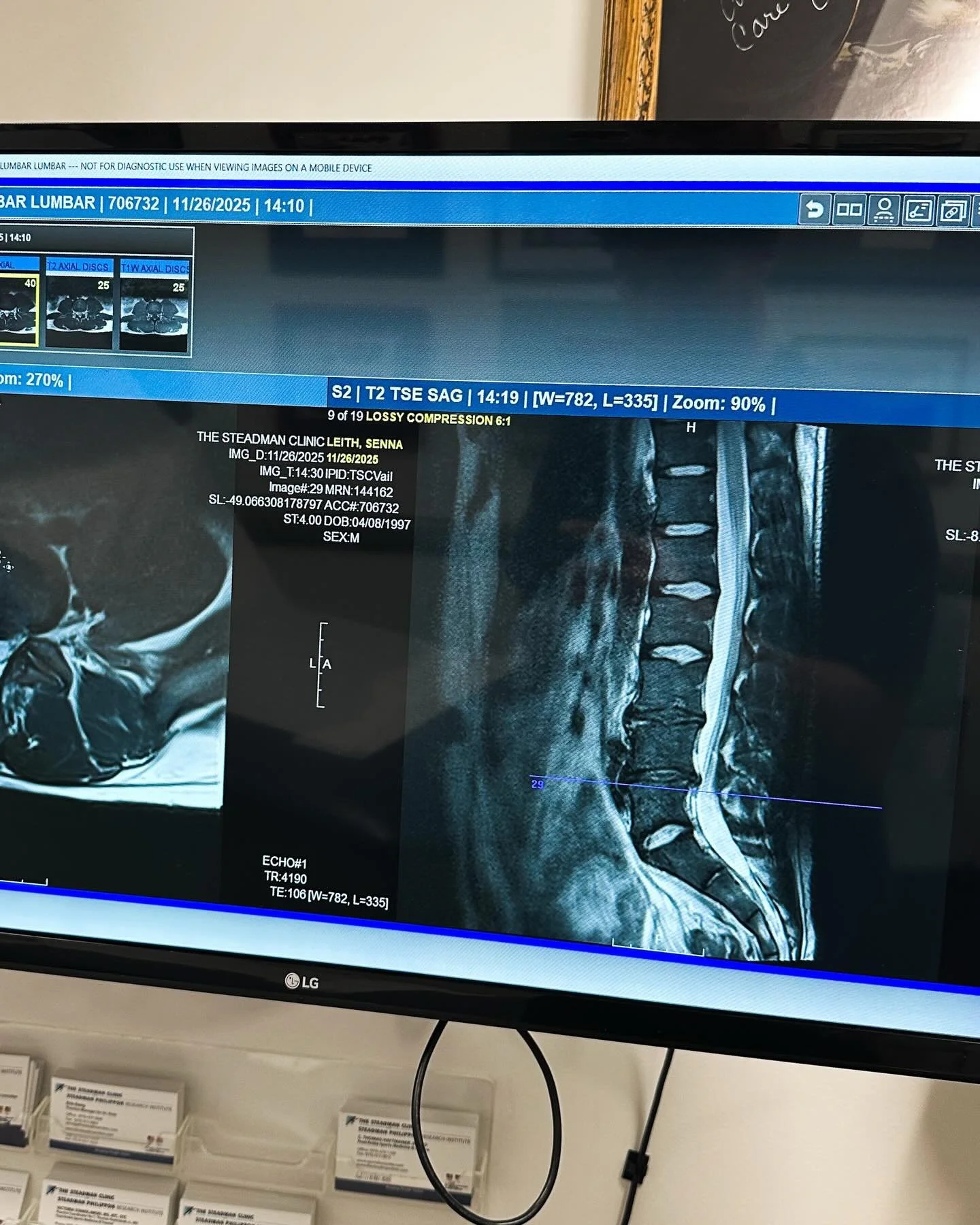 Quick update on things&hellip; Flew to Vail to have my back checked out. The pain became too much, and I needed to take some action. Imaging showed some definitive disc issues including a herniation. I have an injection scheduled to help with the hea
