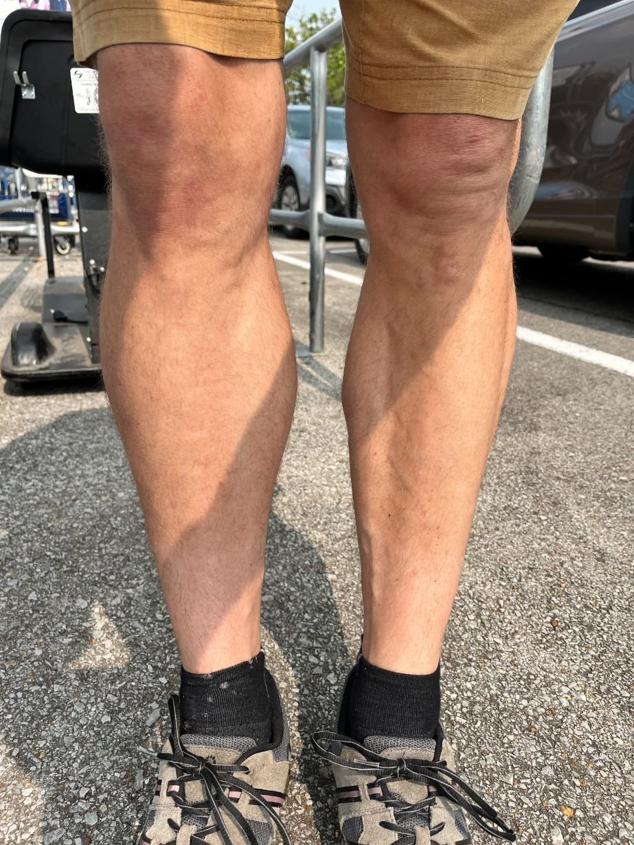 A Torn Calf, A Year of Rehab, and What I Learned Along the Way