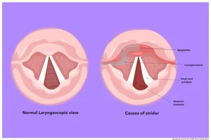 Stridor — A to Z in Head and Neck Surgery