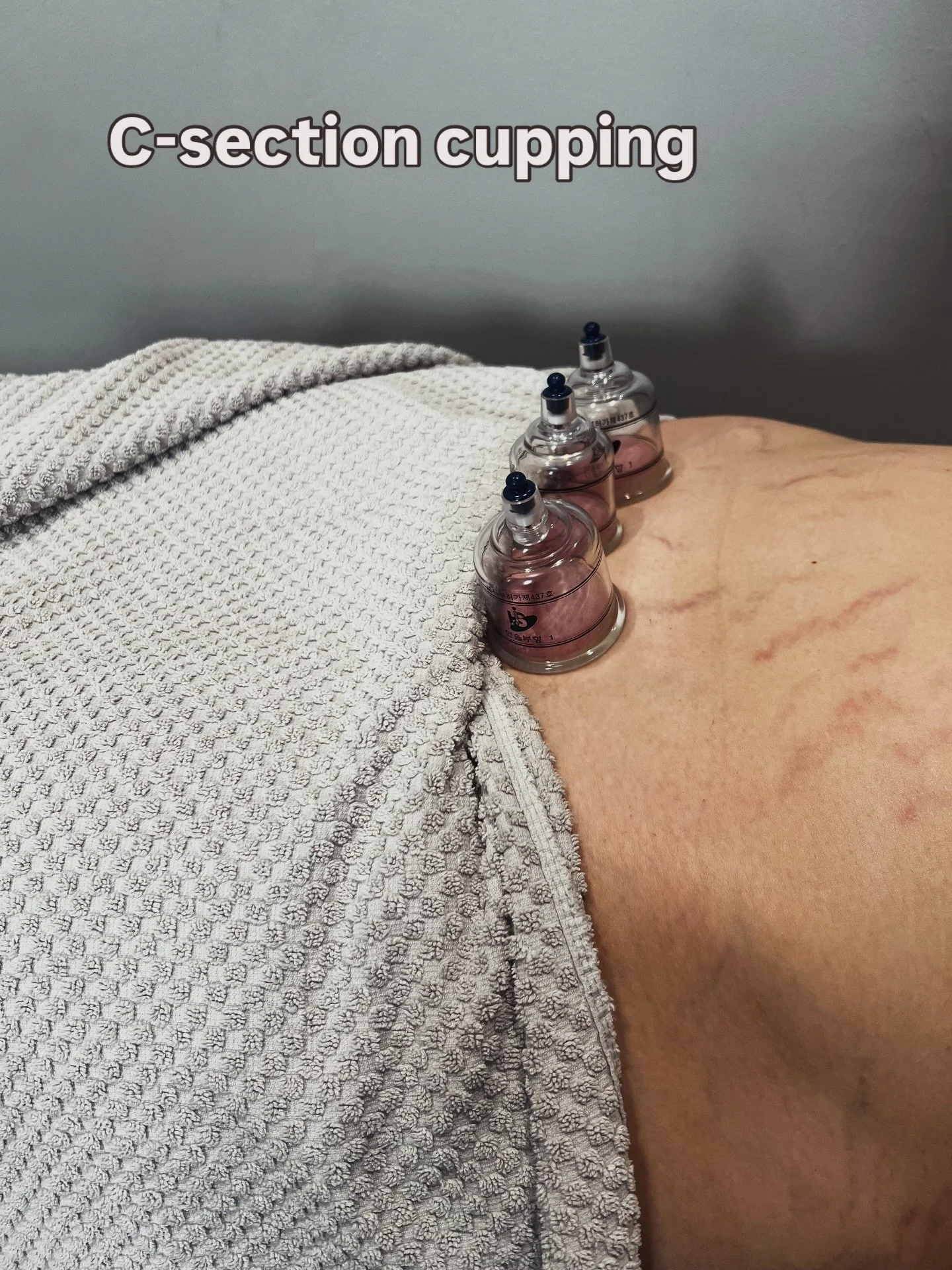 We love treating c-section scars!!

And no &mdash; it&rsquo;s not too late, even years later.

Tight, tethered, or numb scars can contribute to:
&bull; lower tummy &ldquo;doming&rdquo; or weakness
&bull; pelvic floor symptoms
&bull; back or hip pain
