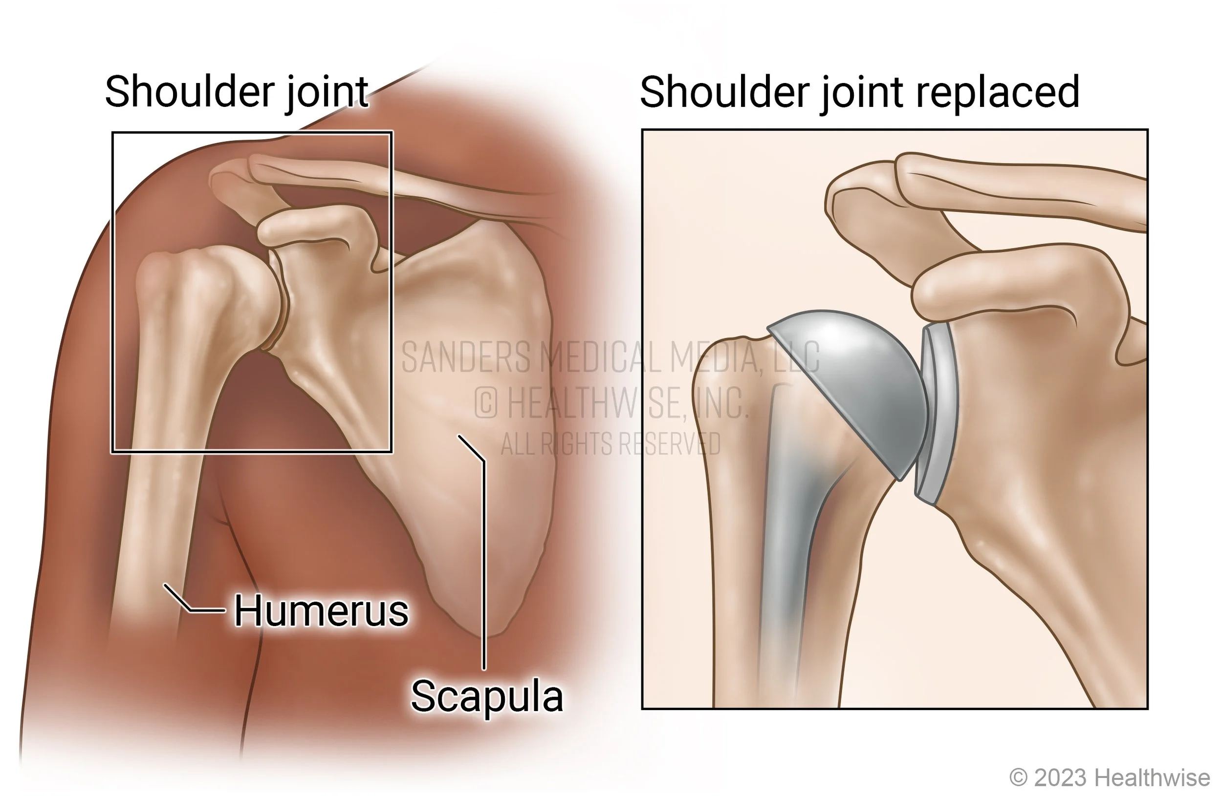 shoulderreplacement.jpg