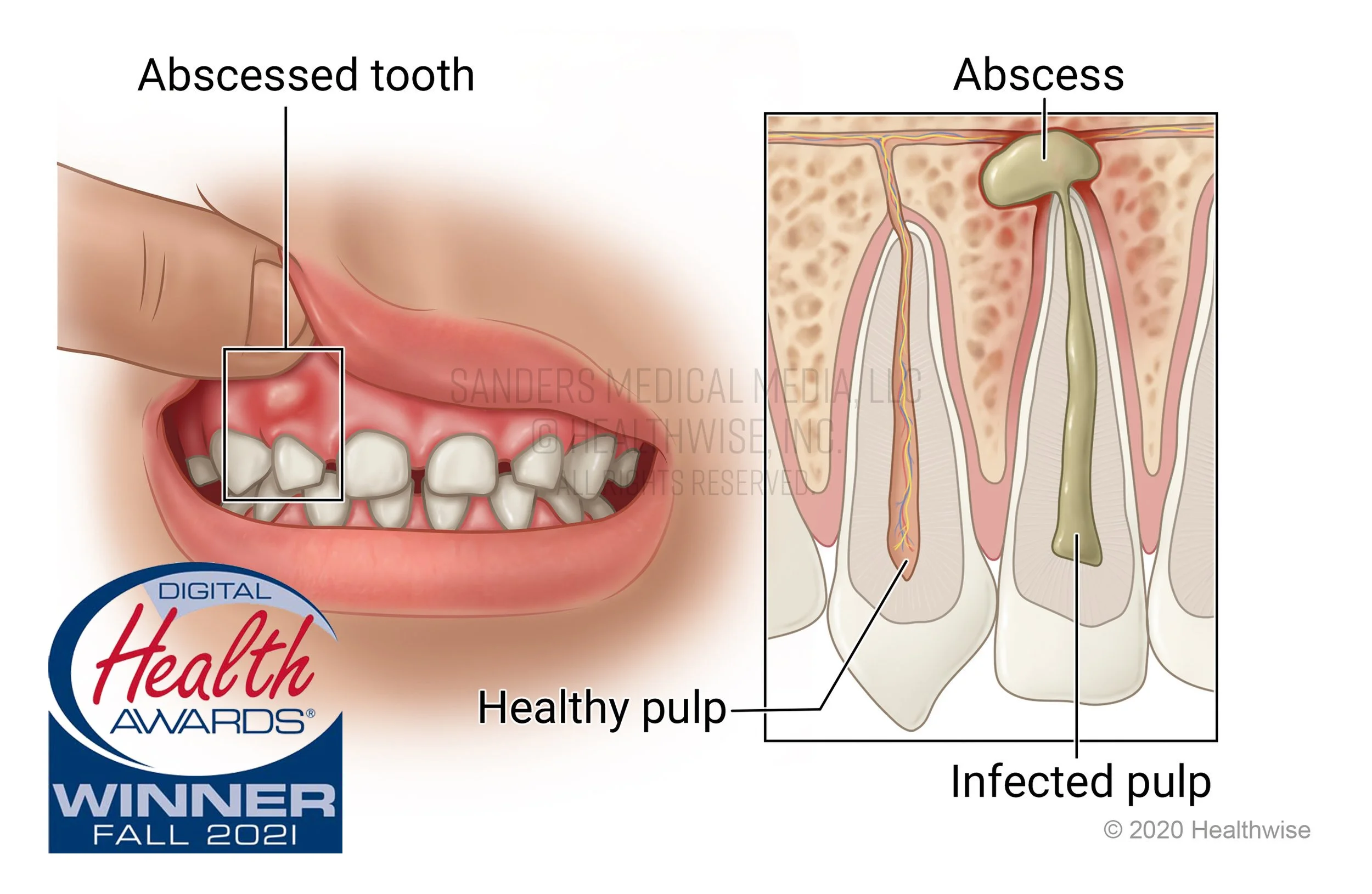 ChildToothAbscess copy.jpg