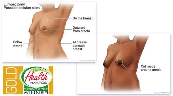 BreastCancerSurgery copy.jpg