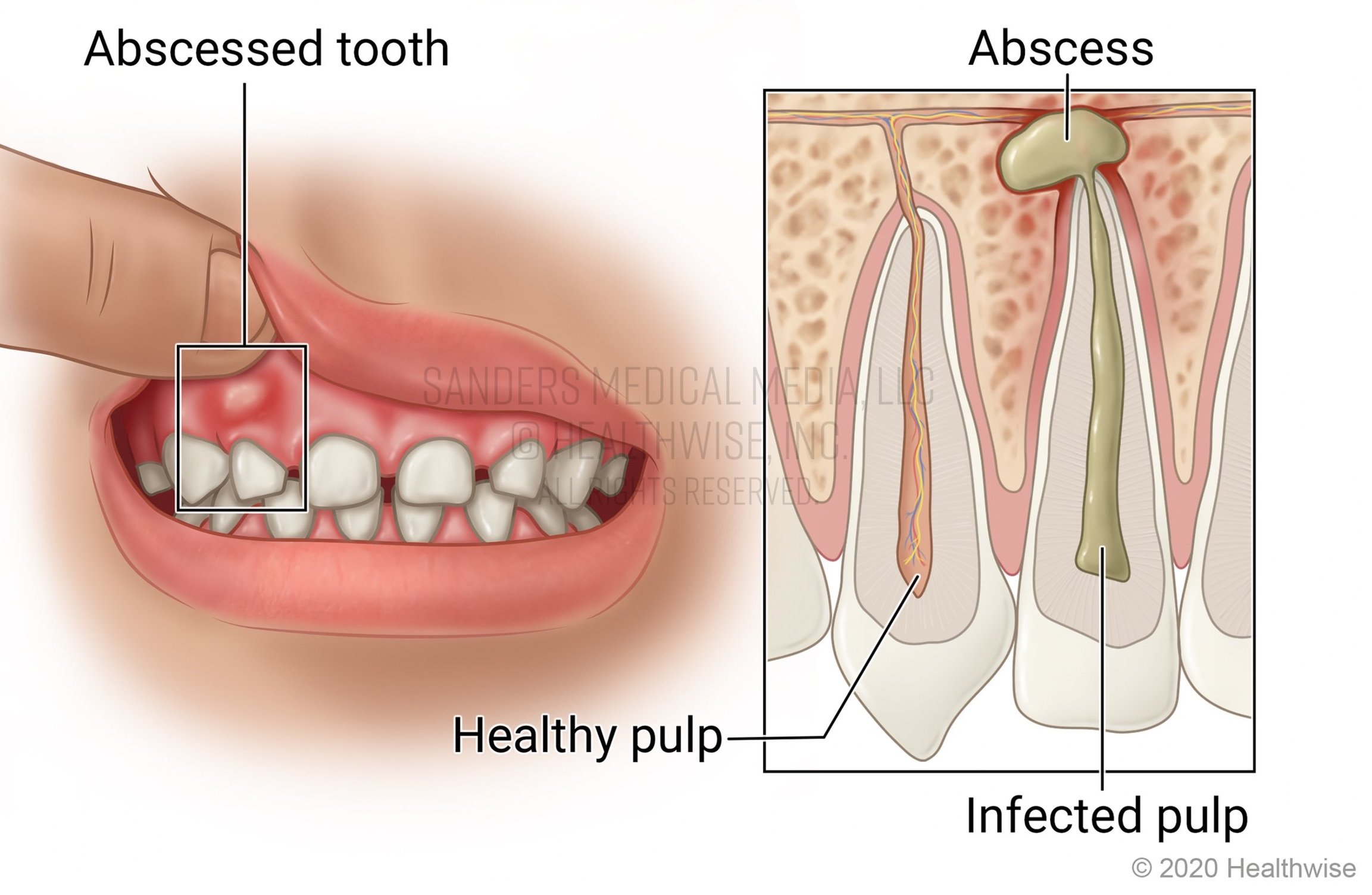 ChildToothAbscess.jpg