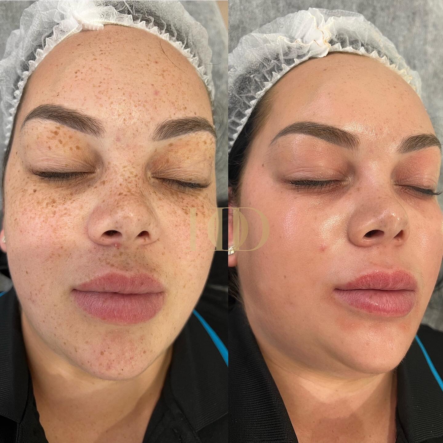 WOW! 🤩
Can you believe these images are 2 weeks apart! 
.
. 
. 
.

#skin #skincare #skincaretips #skingoals #skincorrection #skinhealth #skinclinic #sydneyskinclinic #aesthetic #cosmetics #dermal #specialist #acne #pigmentation #antiaging #results #