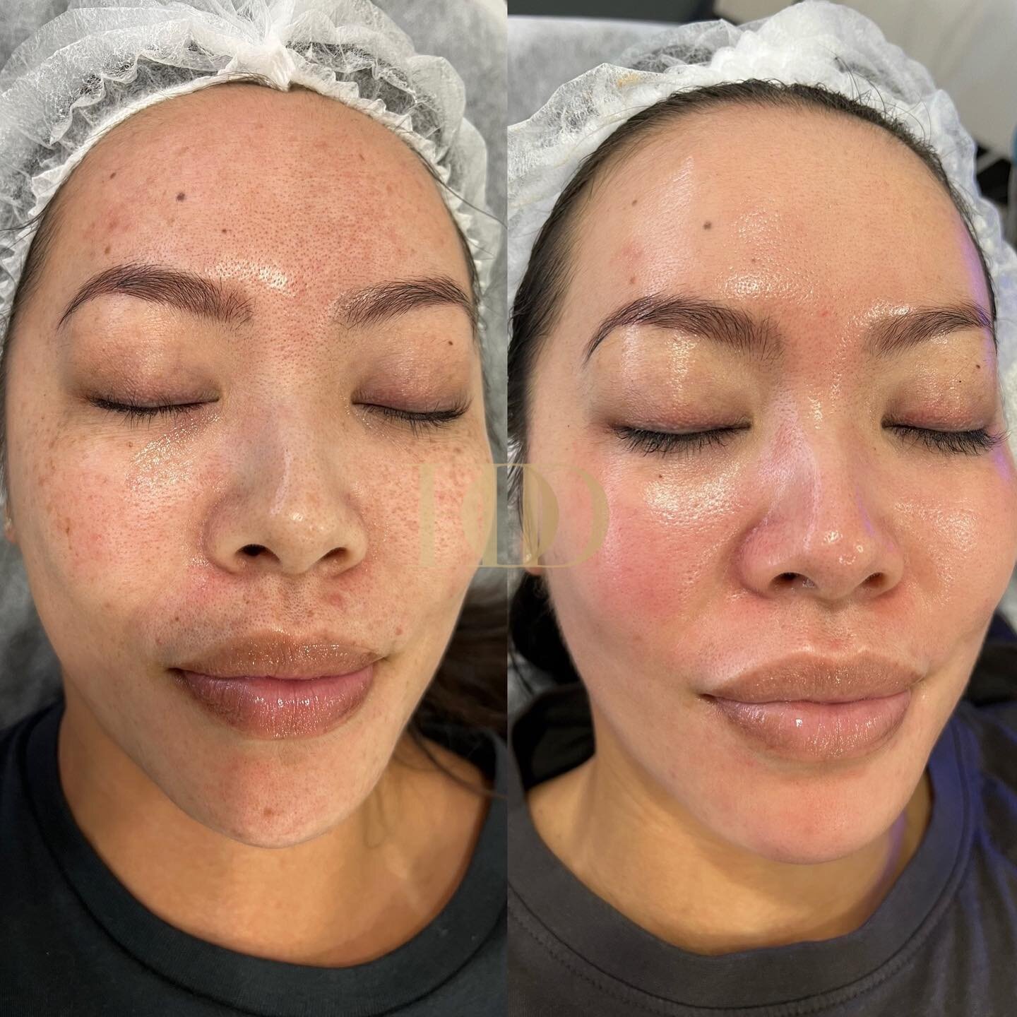 Glossy skin is a vibe ✨
.
.
.
.
.
#skin #skincare #skinclinic #skinhealth #sydneyskinclinic #skincorrection #skinexpert #aesthetic #results #cosmetic #dermal #specialist #acne #pigmentation #antiaging #beautiful #beauty #beforeandafter #transformatio