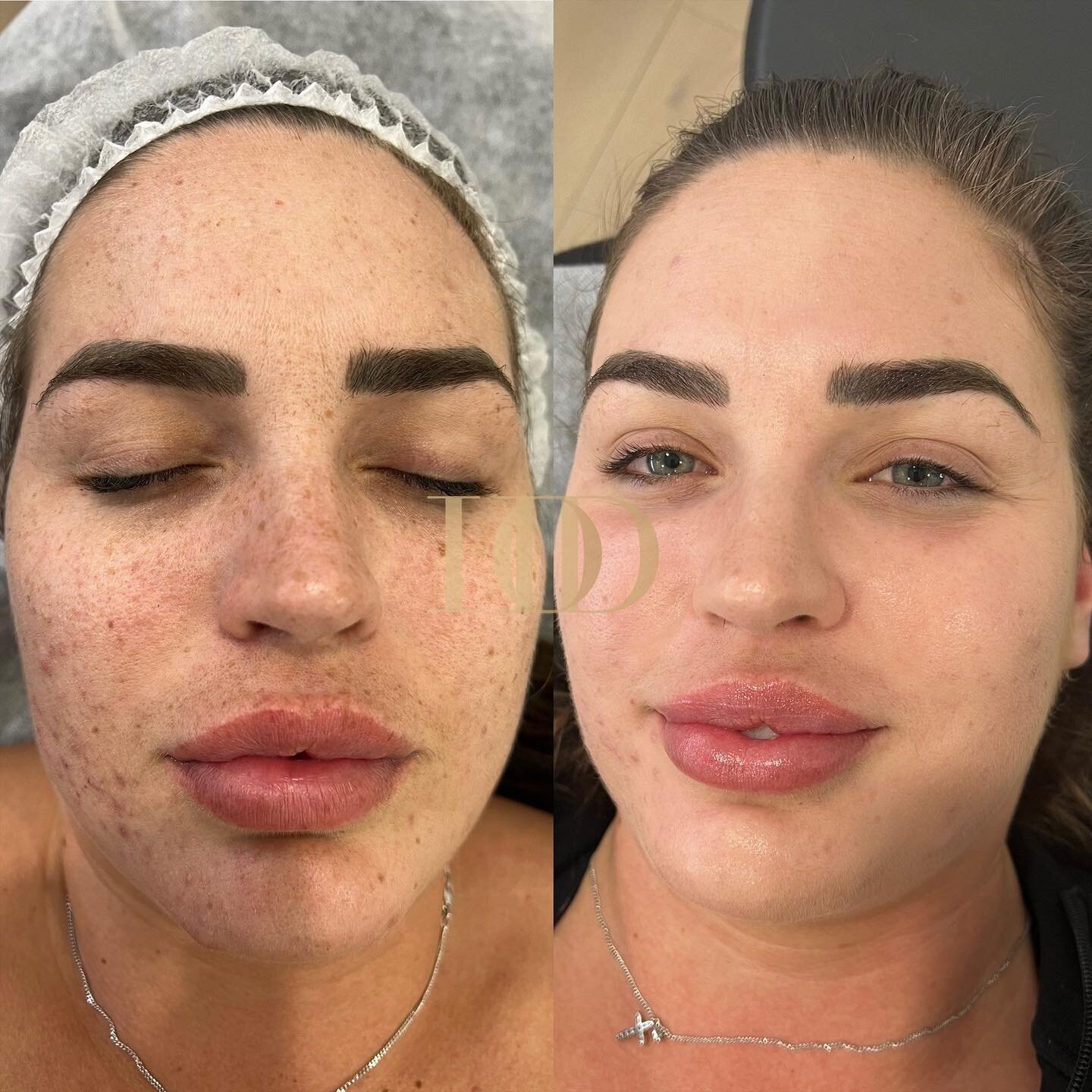 WOW 🤩 
With the combination of treatments and skincare products we have been able to achieve this wonderful transformation for our beautiful @rachie_mua. Cannot wait to see the results as we go on! 
.
.
.
#skin #skincare #skincaretips #skinclinic #s