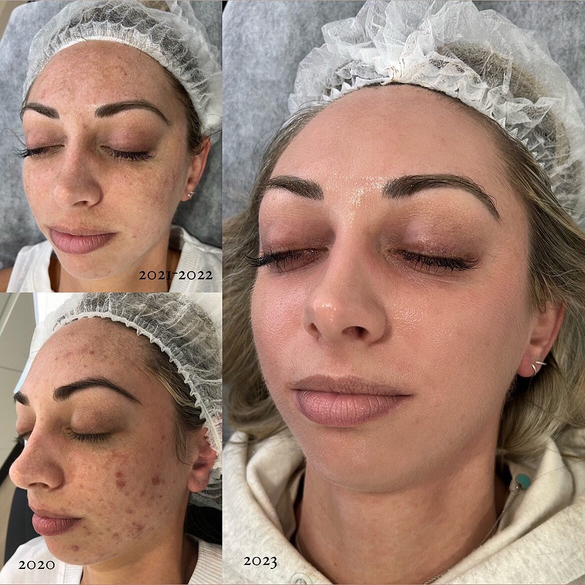 This just shows how much patience and consistency is the key to clear skin. Your skin is like a finger print - not one is the same, meaning that your skin and your friends skin won&rsquo;t be treated the same and your results will differ. 

There is 