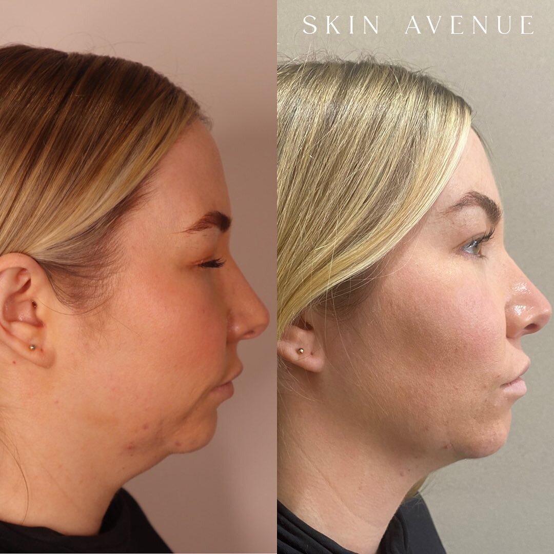 Our beautiful Dermal Therapist Julia has had 2 x TruSculpt treatments to her double chin. 

This is 6 weeks post her first treatment and she has another 6-8 weeks to go before we see her final results. 

We are blown away with the improvement already