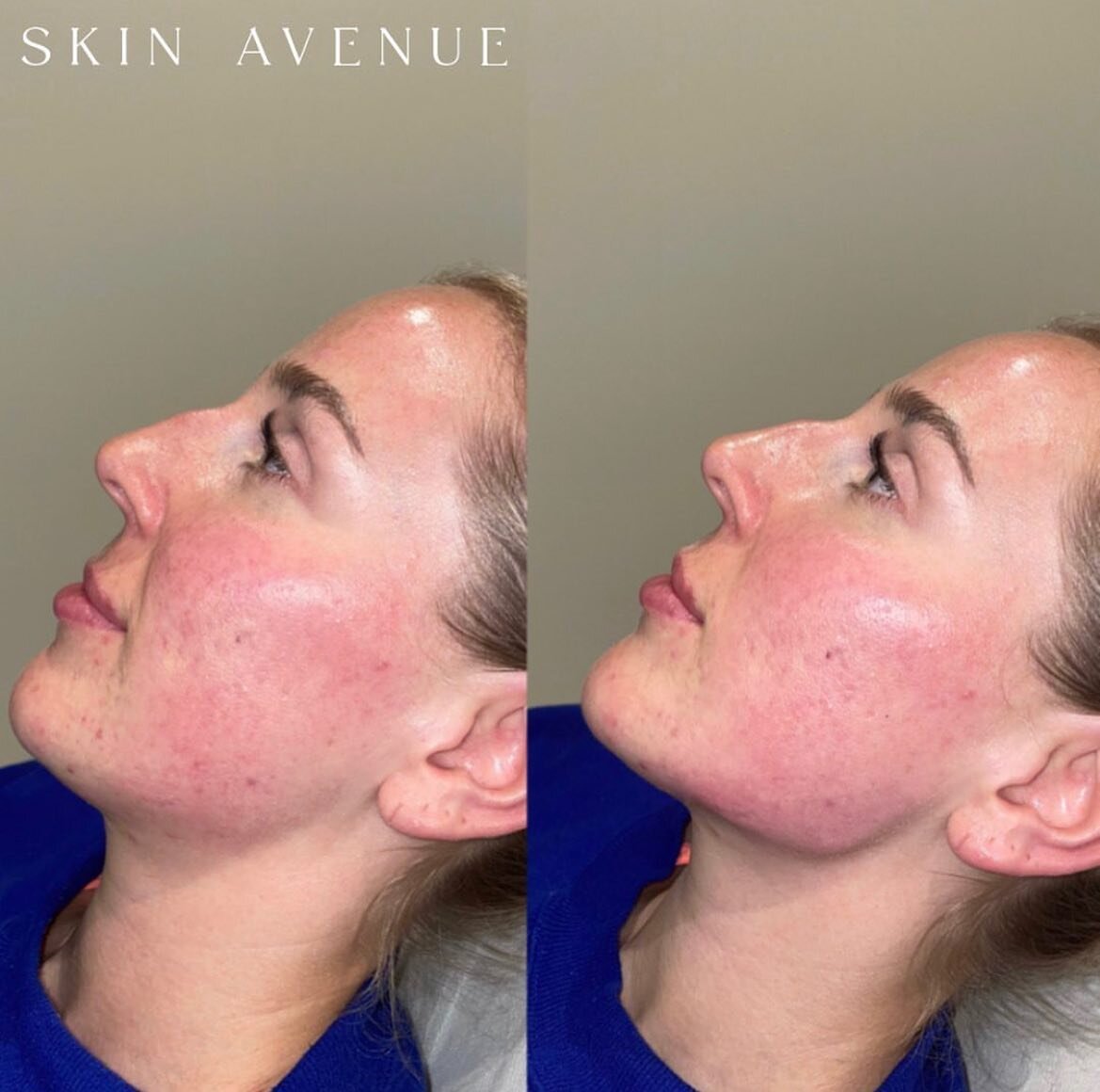 JAWLINE FILLER 🔥

Who can guess how many ml of filler was used to create this beautiful jawline? 🤎
