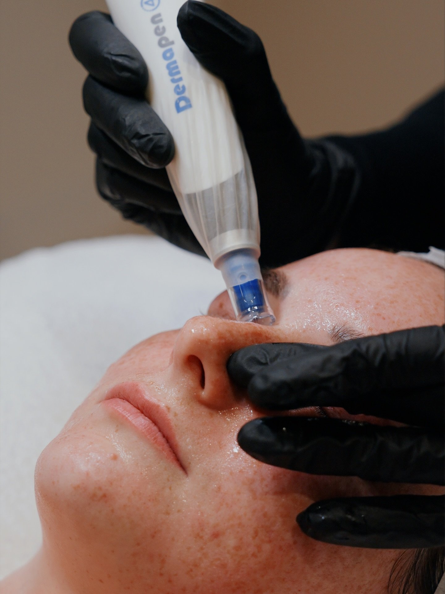 Skin Needling just leveled up! 🤝

Pairing microneedling with Exosomes is the ultimate skin rejuvenation duo. 

Think smoother texture, brighter tone, and faster healing, all thanks to powerful cell-to-cell communication and collagen stimulation.

#S