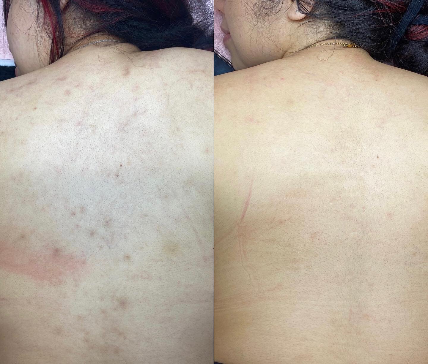 Love to see it!

It gives me such great joy sharing this before and after of my sweet client. She came to me seeking help for her body breakouts and acne marks and now here we are. 

She now feels confident wearing backless dresses and going to to th