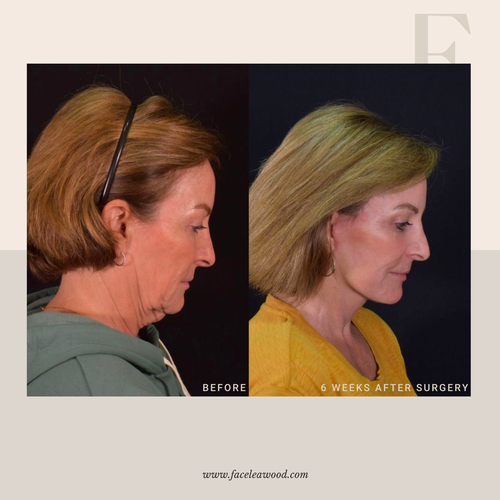 Facelift Kansas City — FACE Leawood