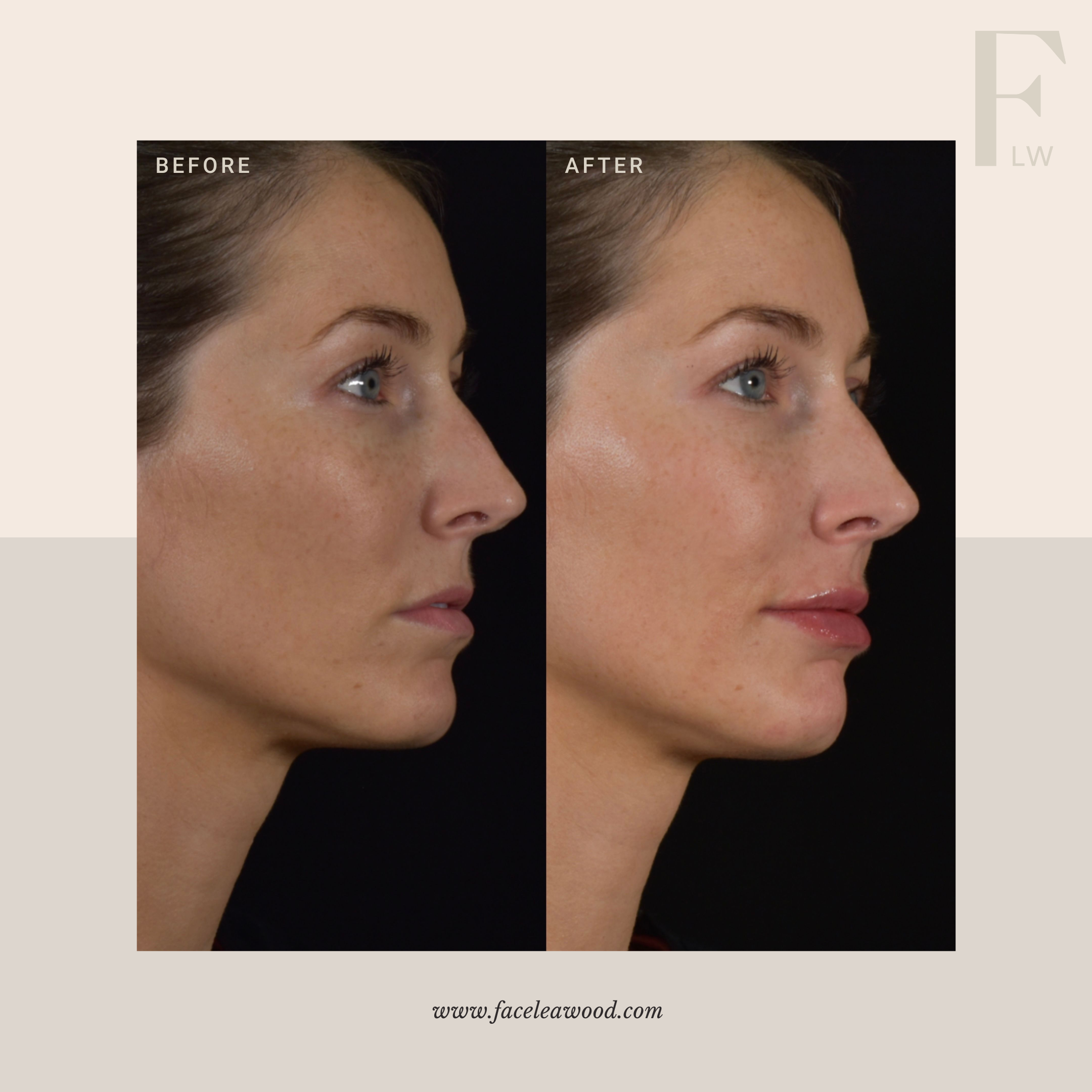 Filler Kansas City — FACE Leawood