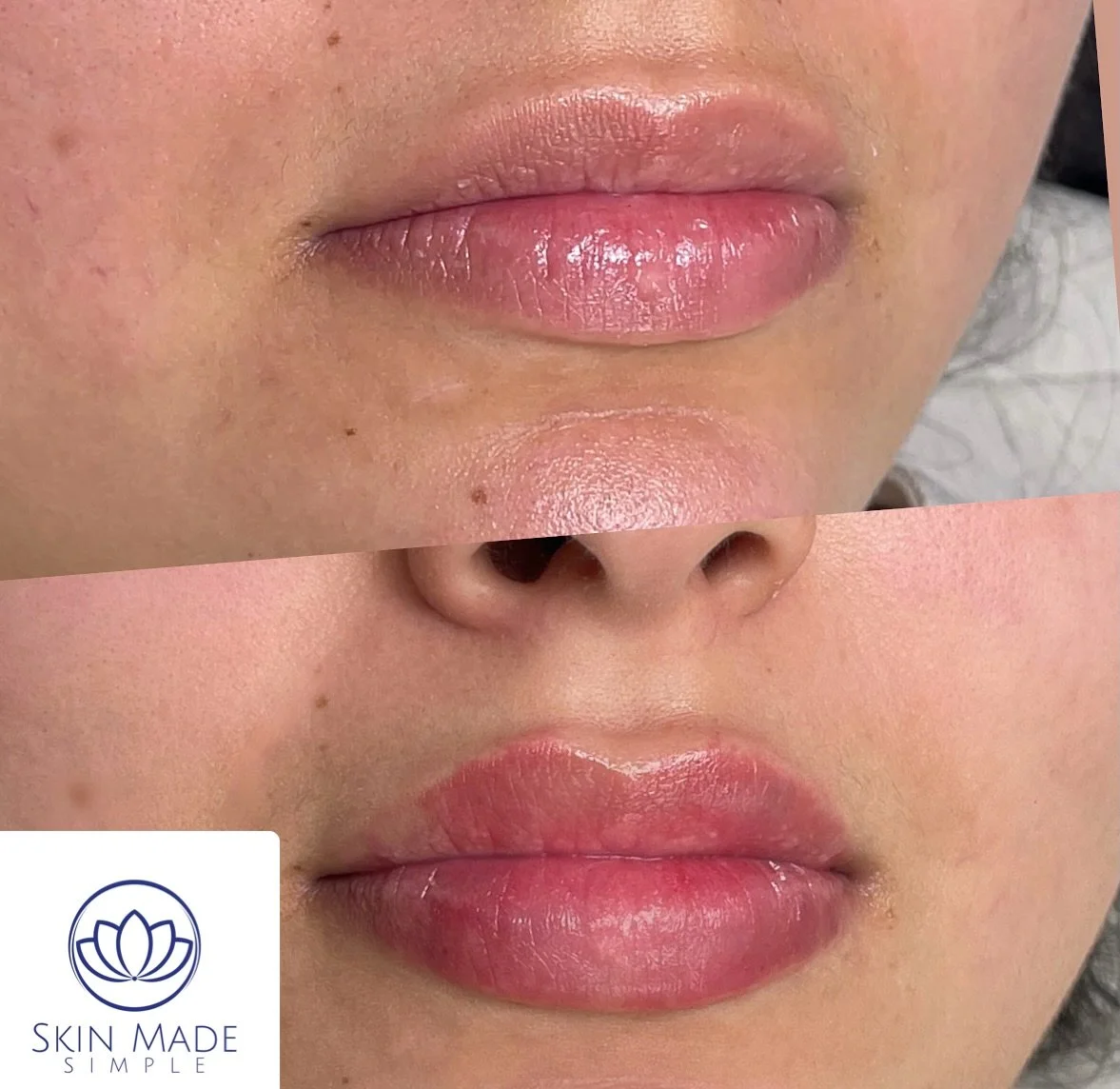 โจBeautiful, natural, and defined lips ๐
Done exclusively today at @ccare_medspa โจ
Soft, elegant results — because less is more when it comes to beauty ๐
๐Bronx, NY
๐ (917)605-5428
๐ง info@skinmadesimple.com
DM us for more info or to book