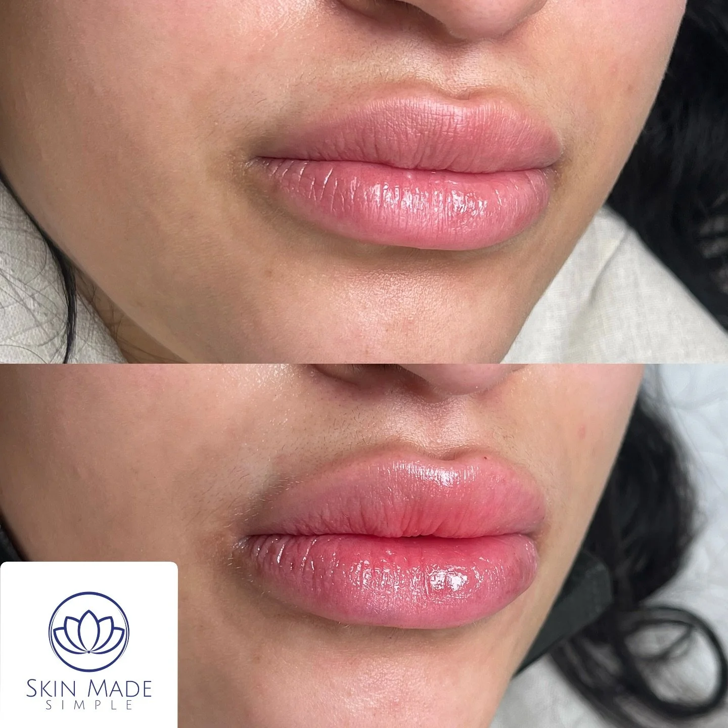Juicy, plumped, and natural-looking lips &mdash; exactly how they should be 😍
Enhance your shape while keeping it soft and balanced 💉

📍 Bronx, NY
📞 Text or call 917-605-5428
📧 info@skinmadesimple.com
💬 DM us to book your appointment!

#SkinMad