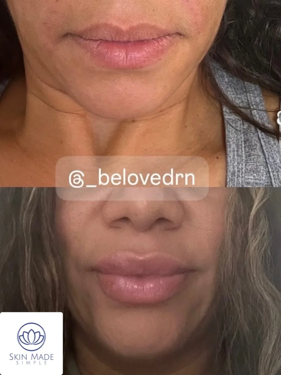 💋 Plump, natural, never overdone. Enhance your lips with confidence at SkinMadeSimple. Done by @_belovedrn 

✨ Subtle volume
✨ Defined shape
✨ Beautifully balanced

📍 Locations: NYC &bull; Bronx &bull; Dobbs Ferry &bull; Orlando
📞 (347) 470-1411
?