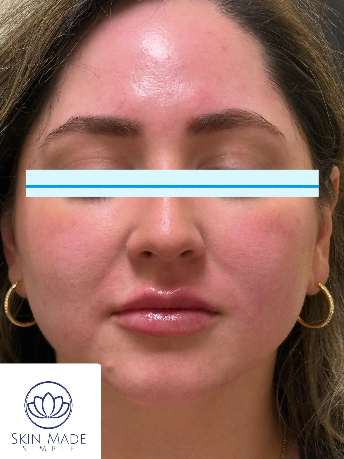 💋 Subtle. Smooth. Stunning.
Enhance your natural beauty with lips that look refreshed, never overdone.

Whether you&rsquo;re going for a soft pout or just a touch of volume &mdash; we&rsquo;ll keep it simple, balanced, and beautifully you.

📍Orland