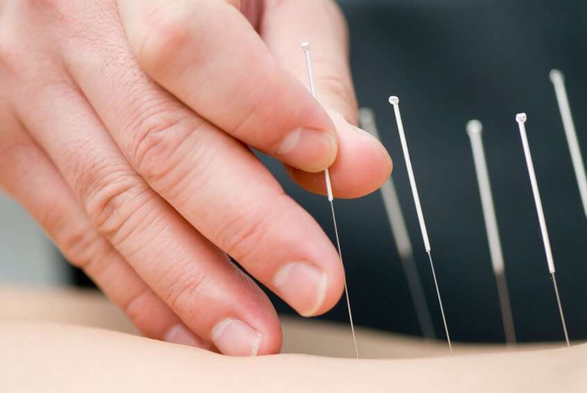 The Healing Art of Acupuncture: Gentle Support for Aging Well