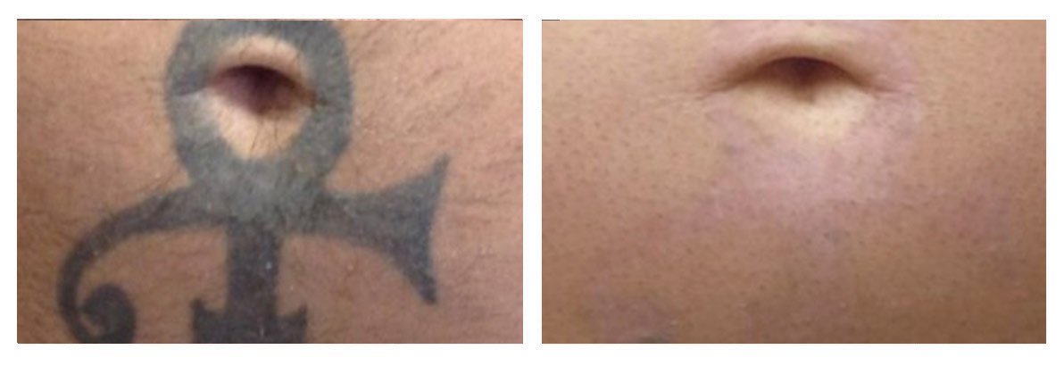 Cleanskin Laser Perth Tattoo Removal – cleanskinlaser
