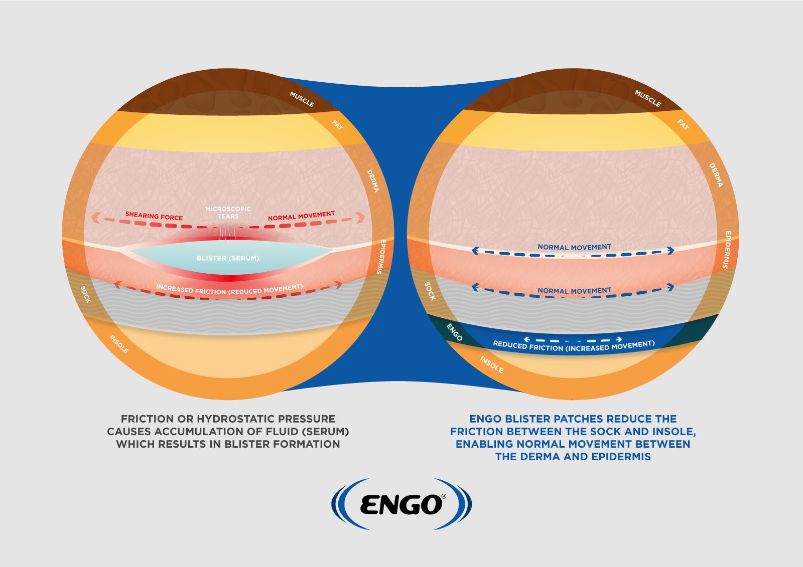 engo-prevent-blisters-patches-1.jpg