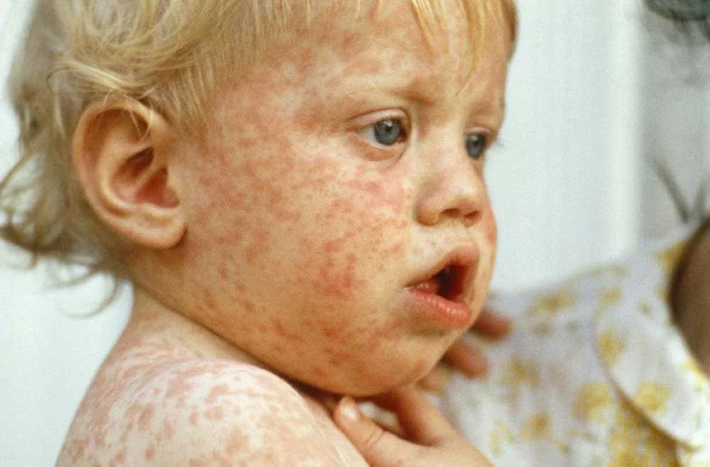When Measles Strikes: Exposure, Treatment, and Public Health Response