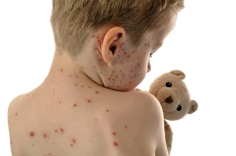 Measles Vaccination and Prevention: Protecting Your Child and Community