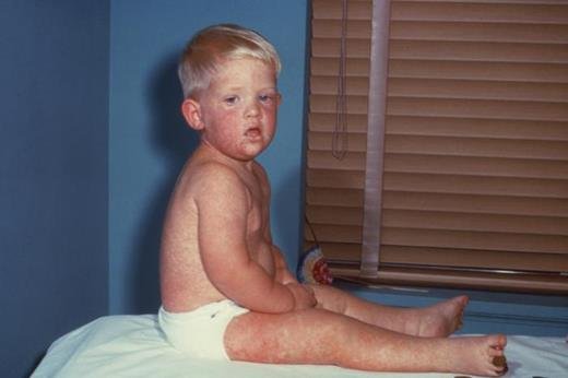 Understanding Measles: What Every Parent Should Know