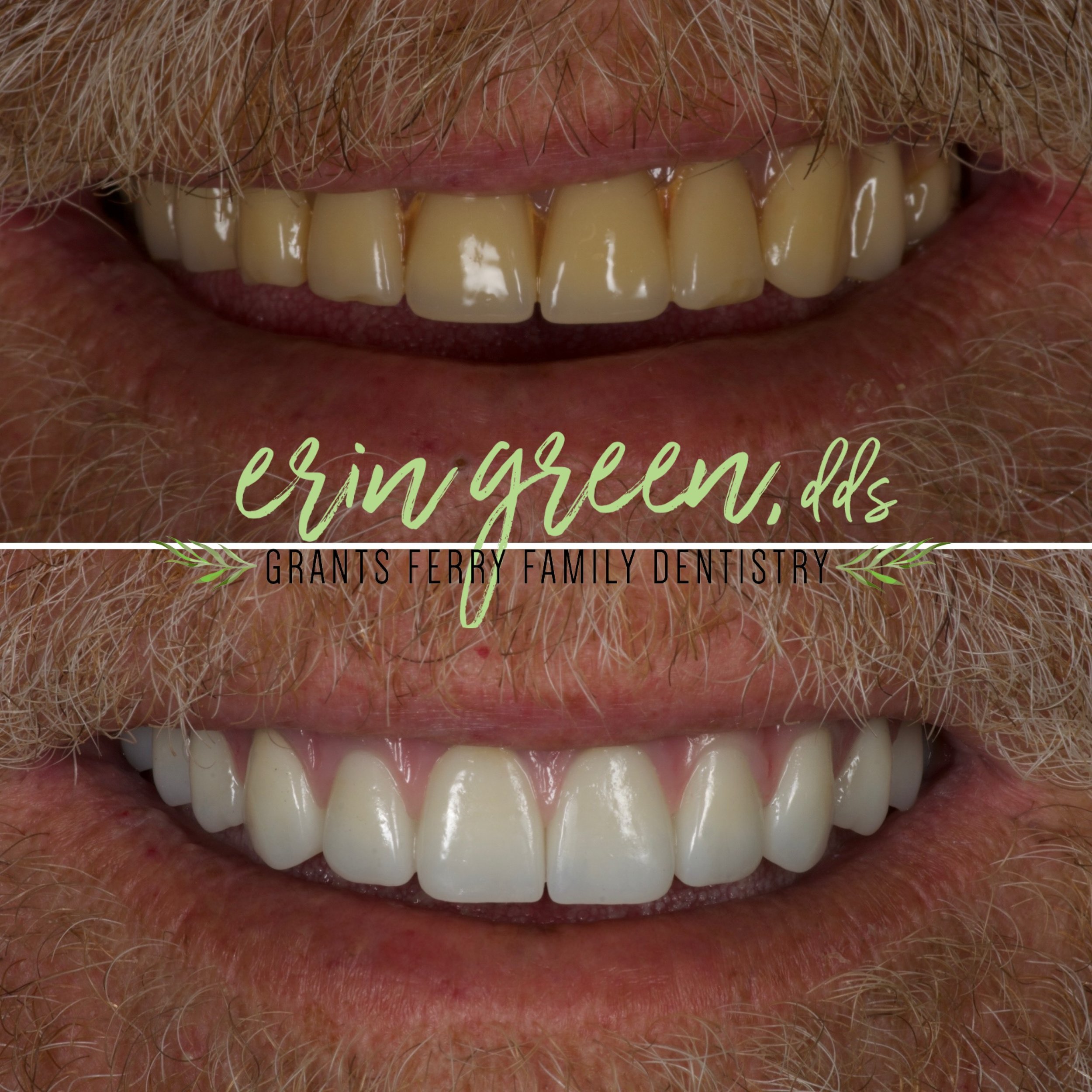 A whiter and brighter smile upgrade for this gentleman!🤩 Is it time to refresh your smile?
&bull;
&bull;
🦷 Ready to transform your smile? Virtual consultations are FREE &amp; easy!
📄THE PROCESS
Step 1️⃣ Upload a photo and share what you would like