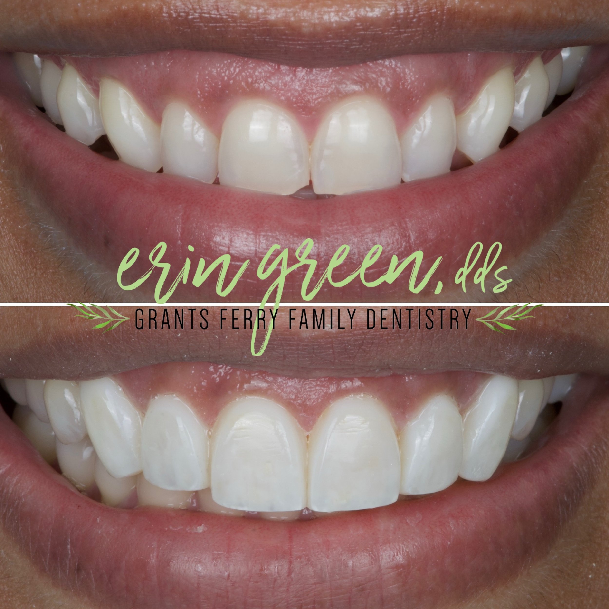 ✨ Transform your smile with a noninvasive smile enhancement! 😁 Say goodbye to gummy smiles and hello to a confident grin with a gum lift and composite veneers. No drilling of your natural teeth!🌟 Boost your confidence and dazzle with every smile! C