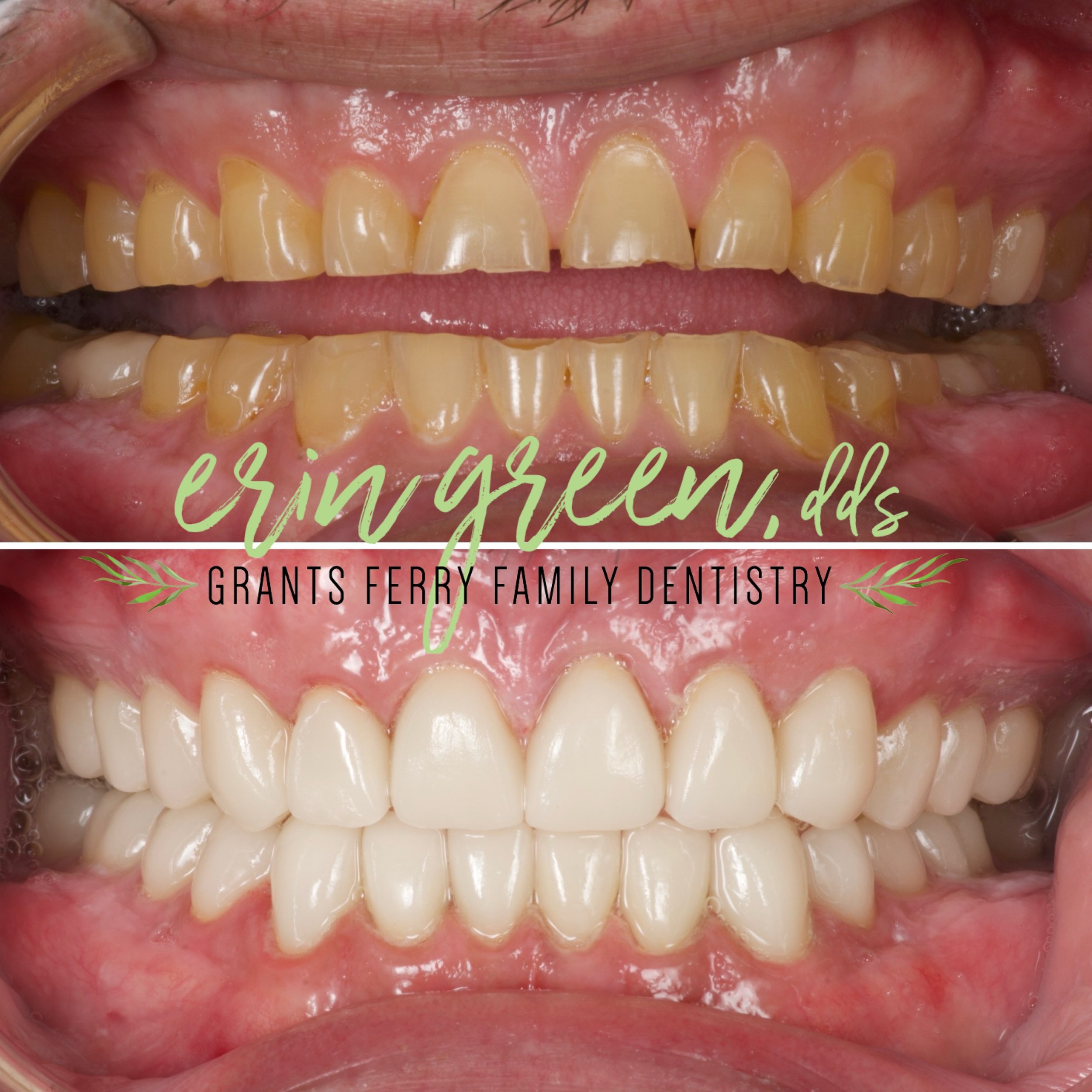 🌟 Smile Transformation Alert! 🌟

📸 Check out this amazing smile makeover! Years of grinding and clenching took its toll, but the results speak for themselves! This patient&rsquo;s smile is now healthier, more attractive, and full of confidence.
&b