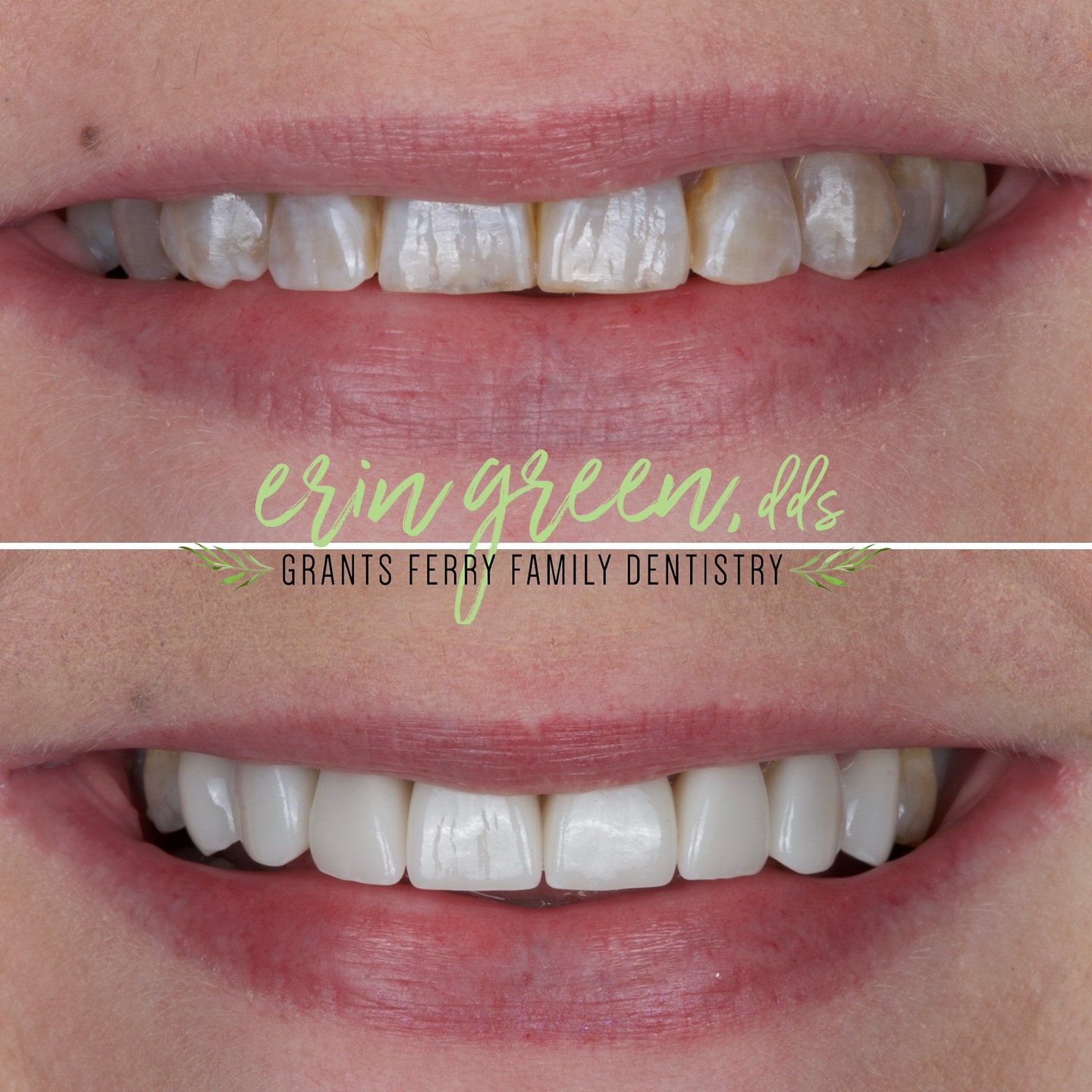 ✨ Smile Transformation Alert! ✨

One of our favorite makeovers at Grants Ferry Family Dentistry was transforming this beautiful smile affected by tetracycline staining. This type of deep discoloration can take a toll on confidence, making people hesi