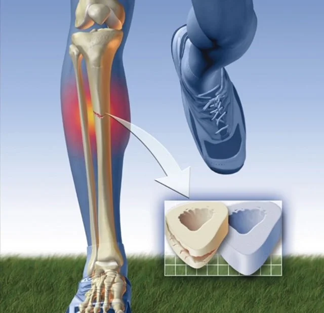 Spring Running and Stress Fractures 