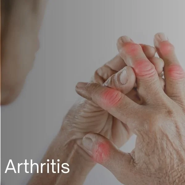 Arthritis