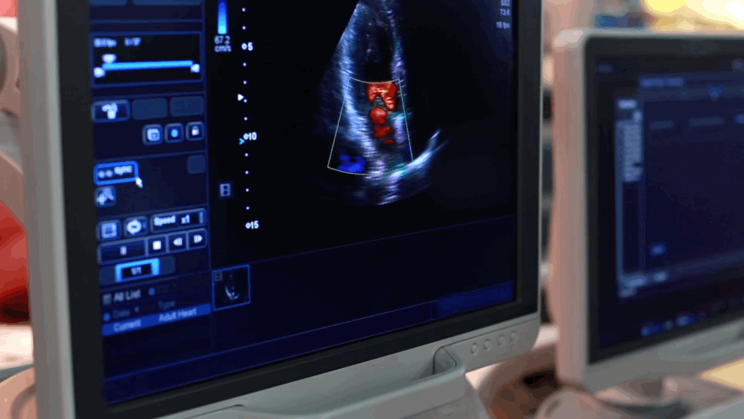 Echocardiogram cardiac ultrasound image