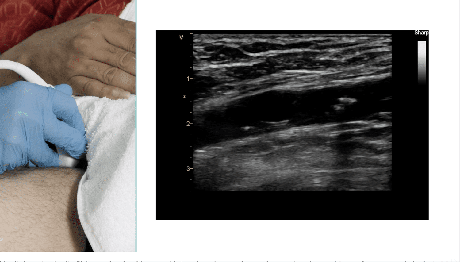 Peripheral arterial duplex ultrasound image