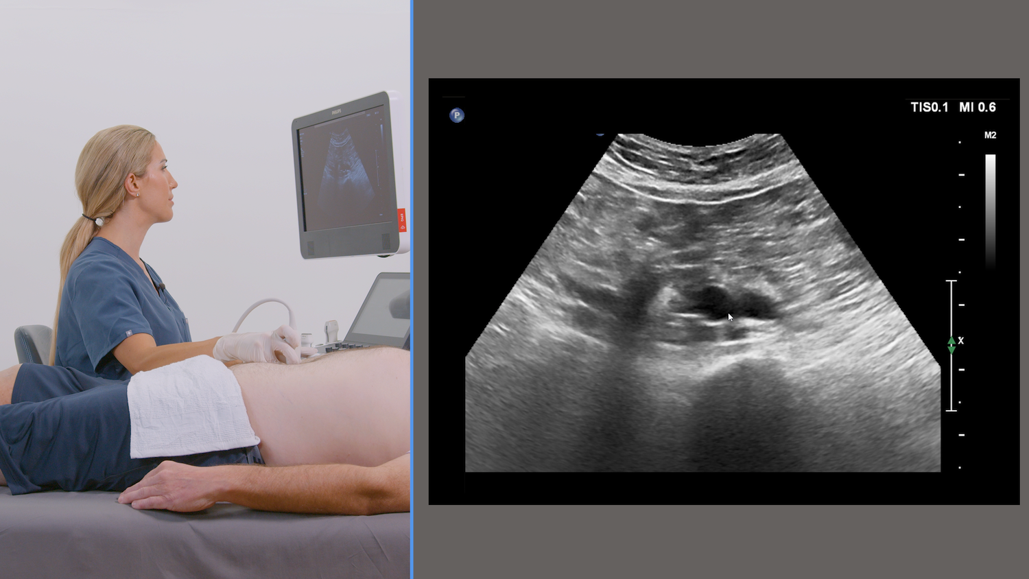 Central venous ultrasound imaging