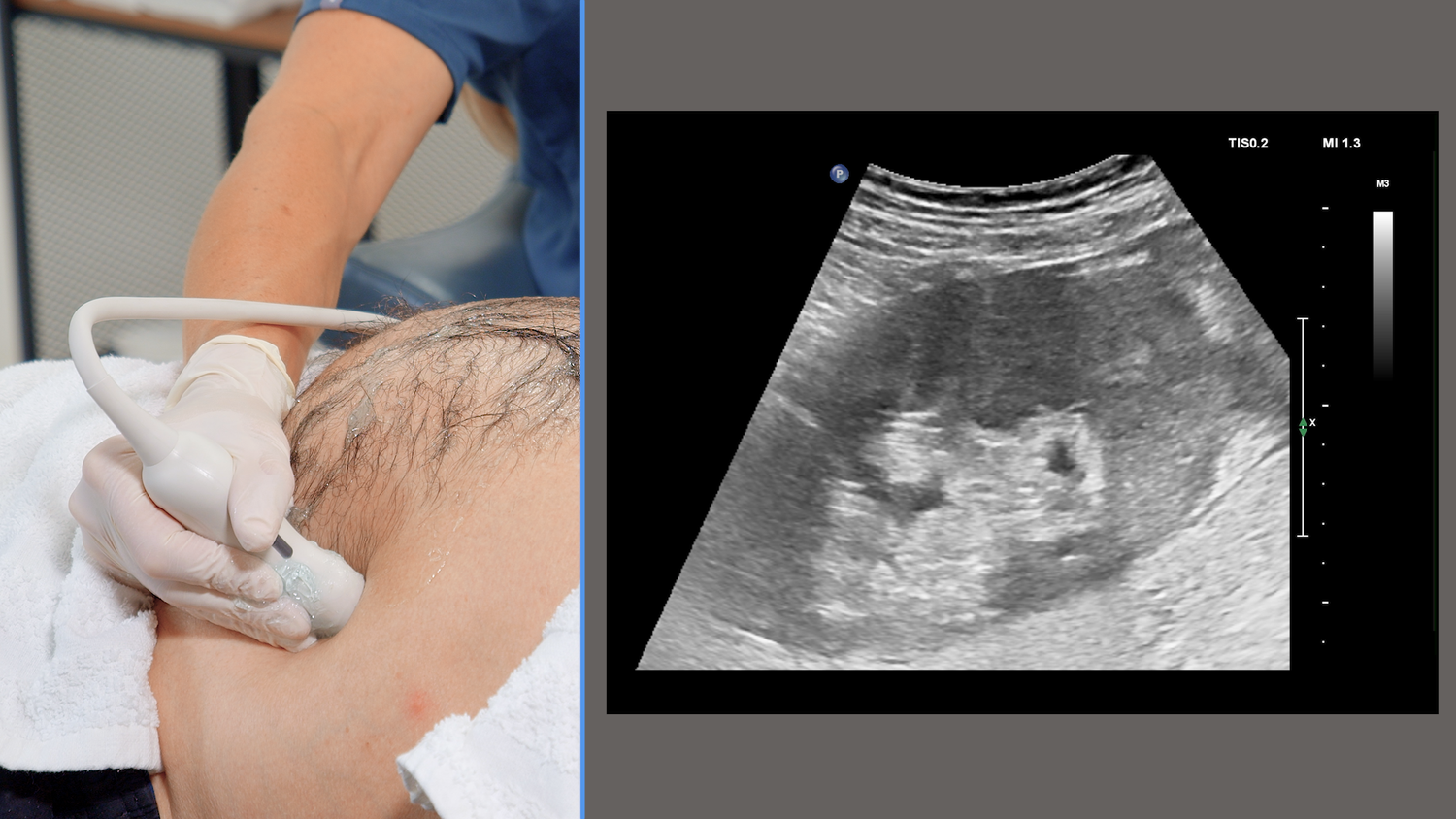 Renal artery Doppler ultrasound image