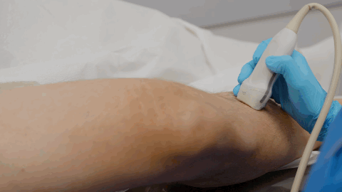 UUDVT sonographer performing an ultrasound exam