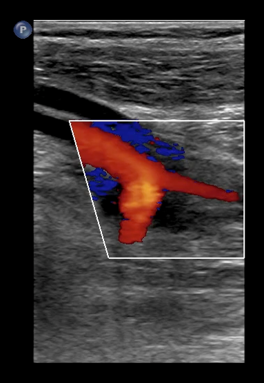 Arterial Image.png