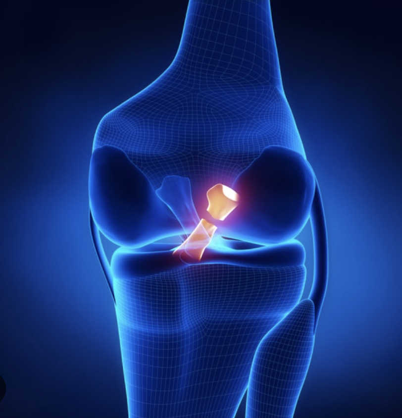 ACL Surgery: What to Expect Before Surgery 
