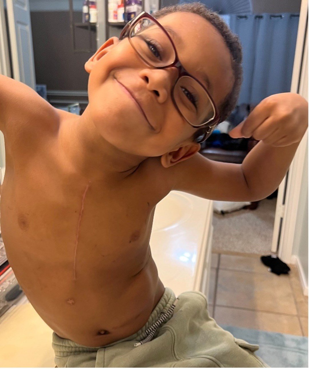 One of the Harry twins smiling in a health care setting with a surgery scar on his chest.