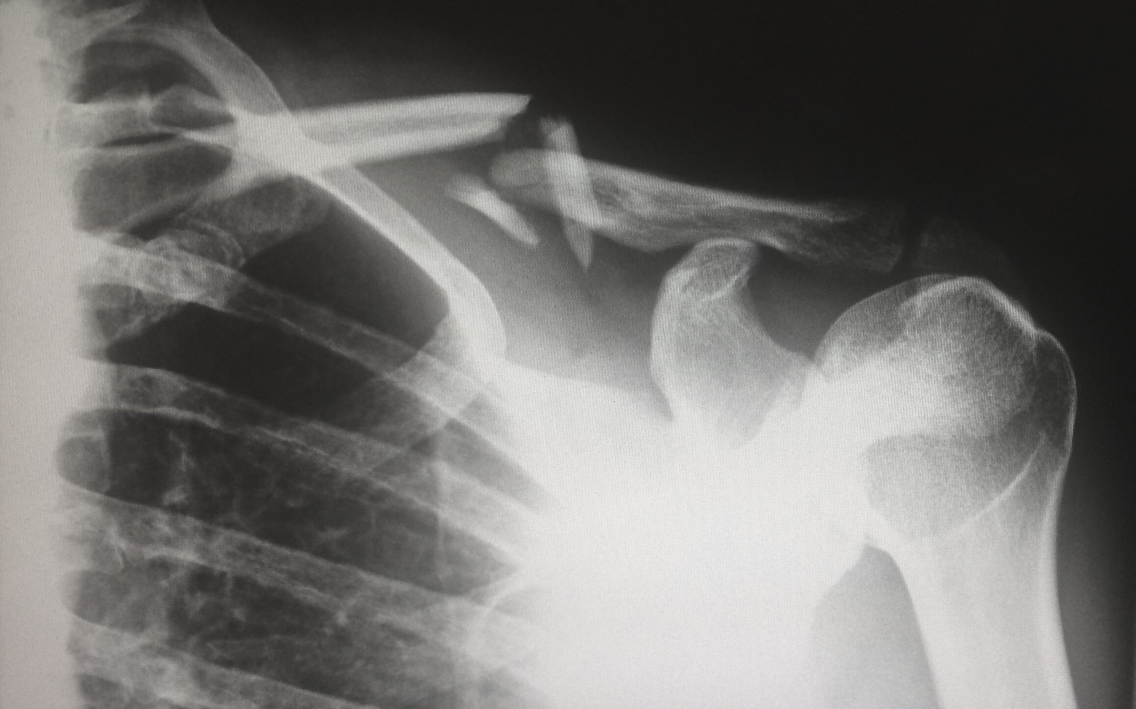 X-ray image of a human shoulder and upper rib cage.