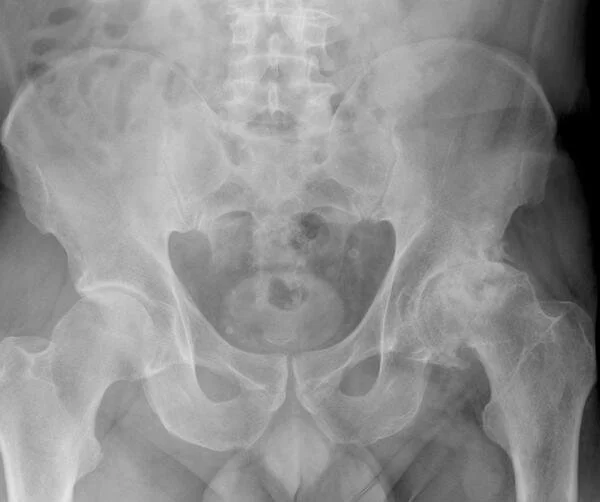 Коксартроза на лява тазобедрена става