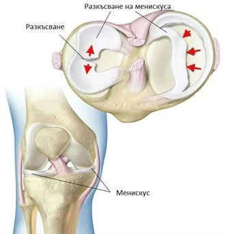 Видове разкъсвания на менискусите в колянна става