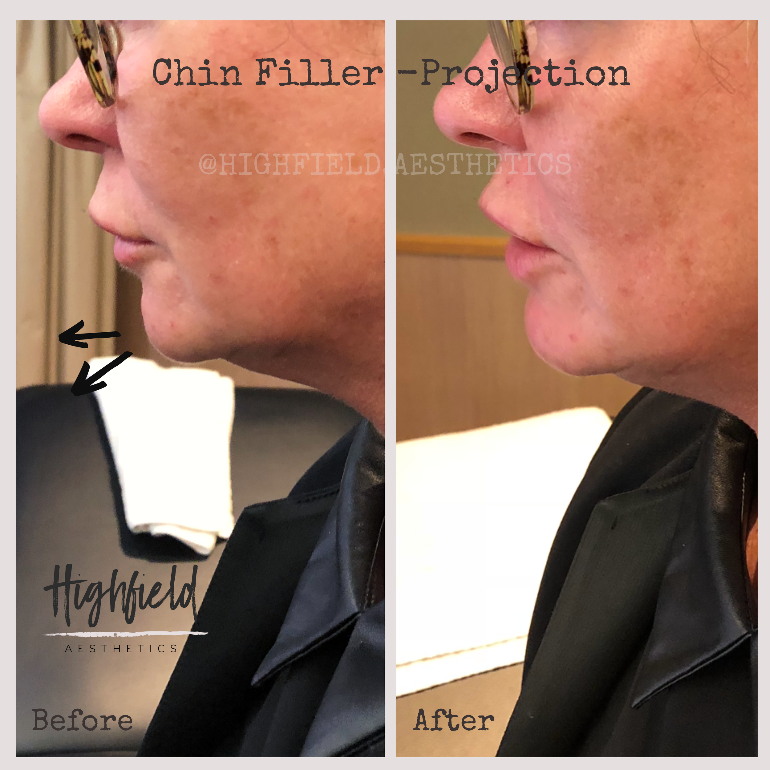 Copy of Copy of Chin projection  (1).png