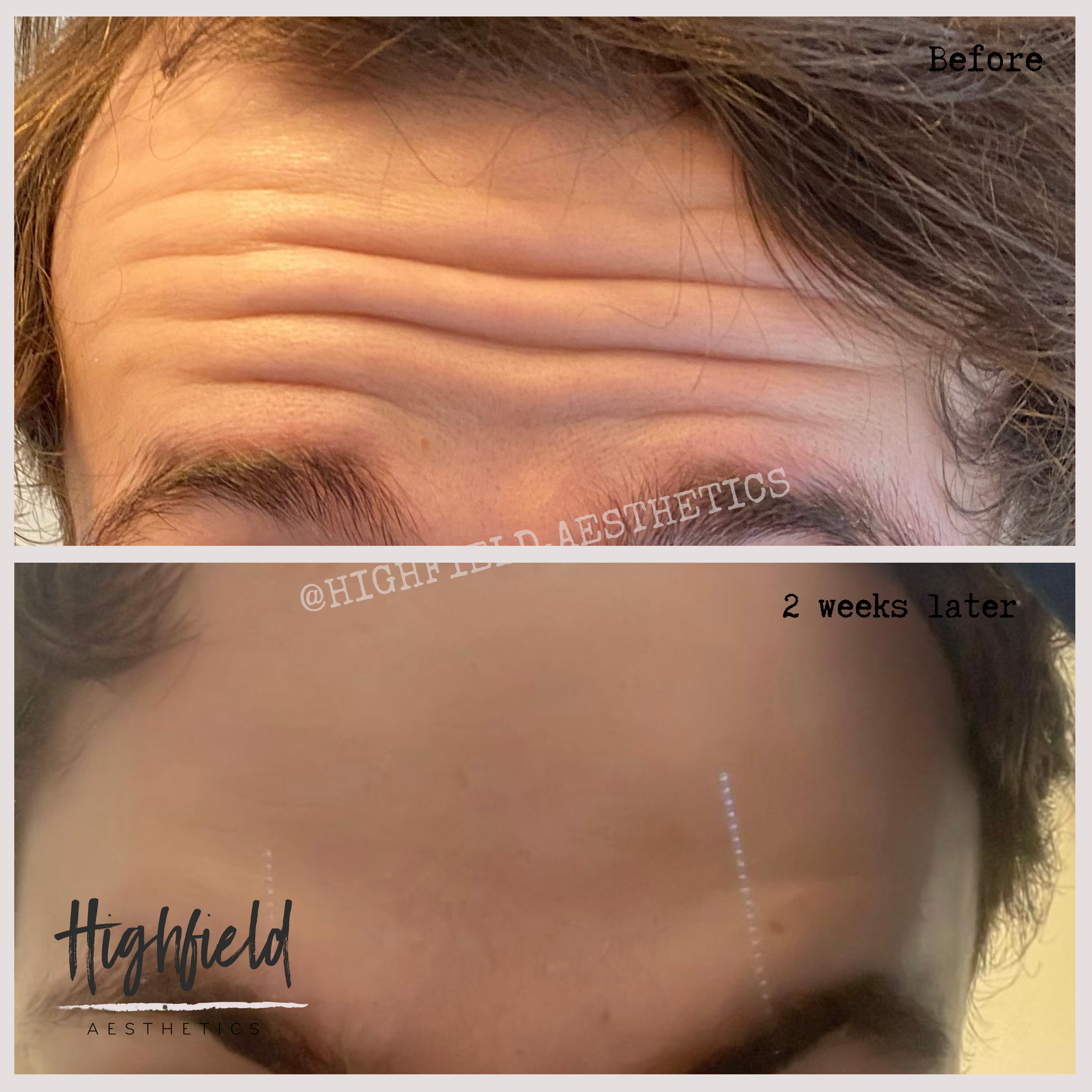 Copy of Nasolabial folds (2).png