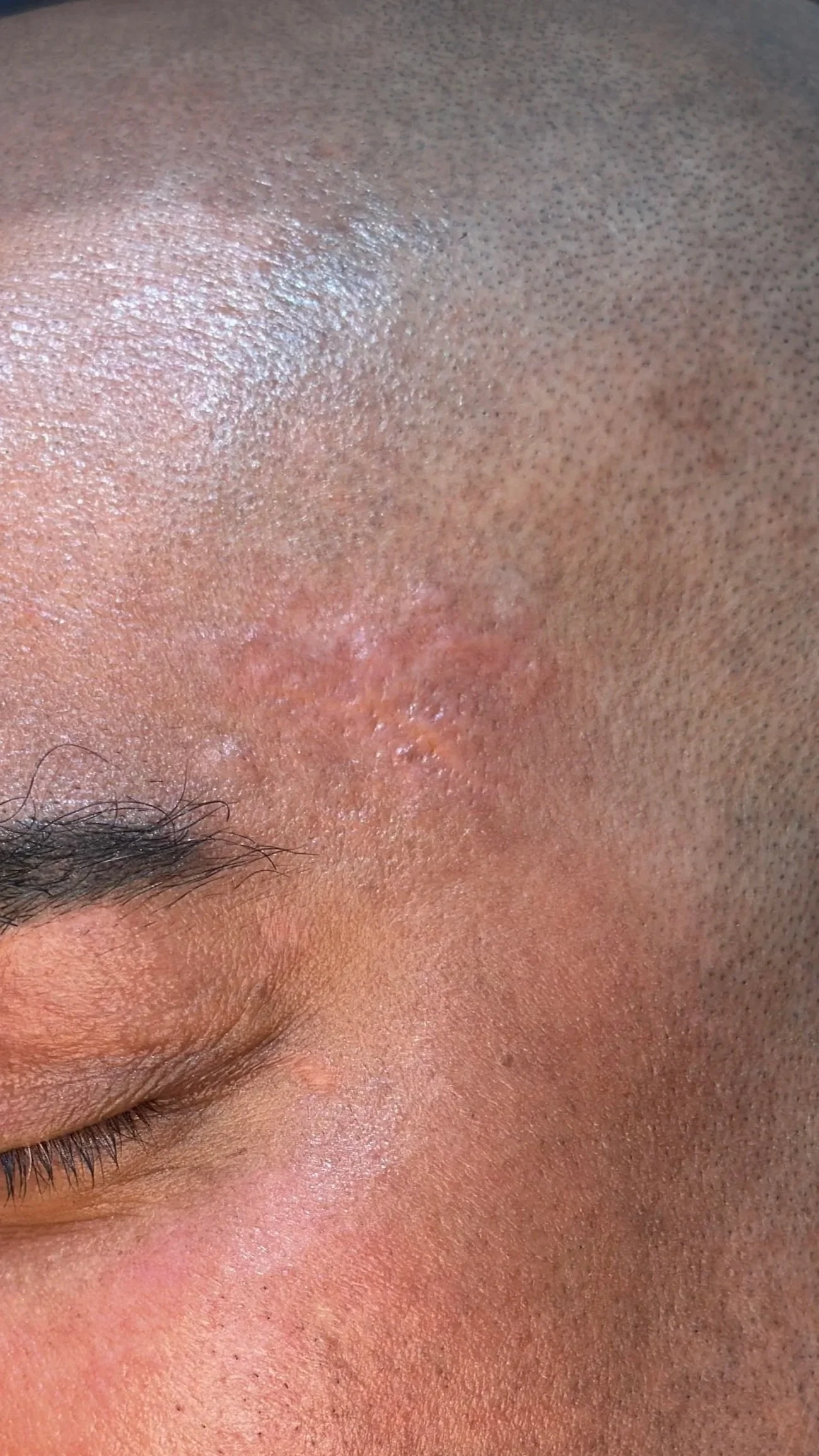 Skin Camouflage: A Closer Look at the Process, the Healing, and What to Expect