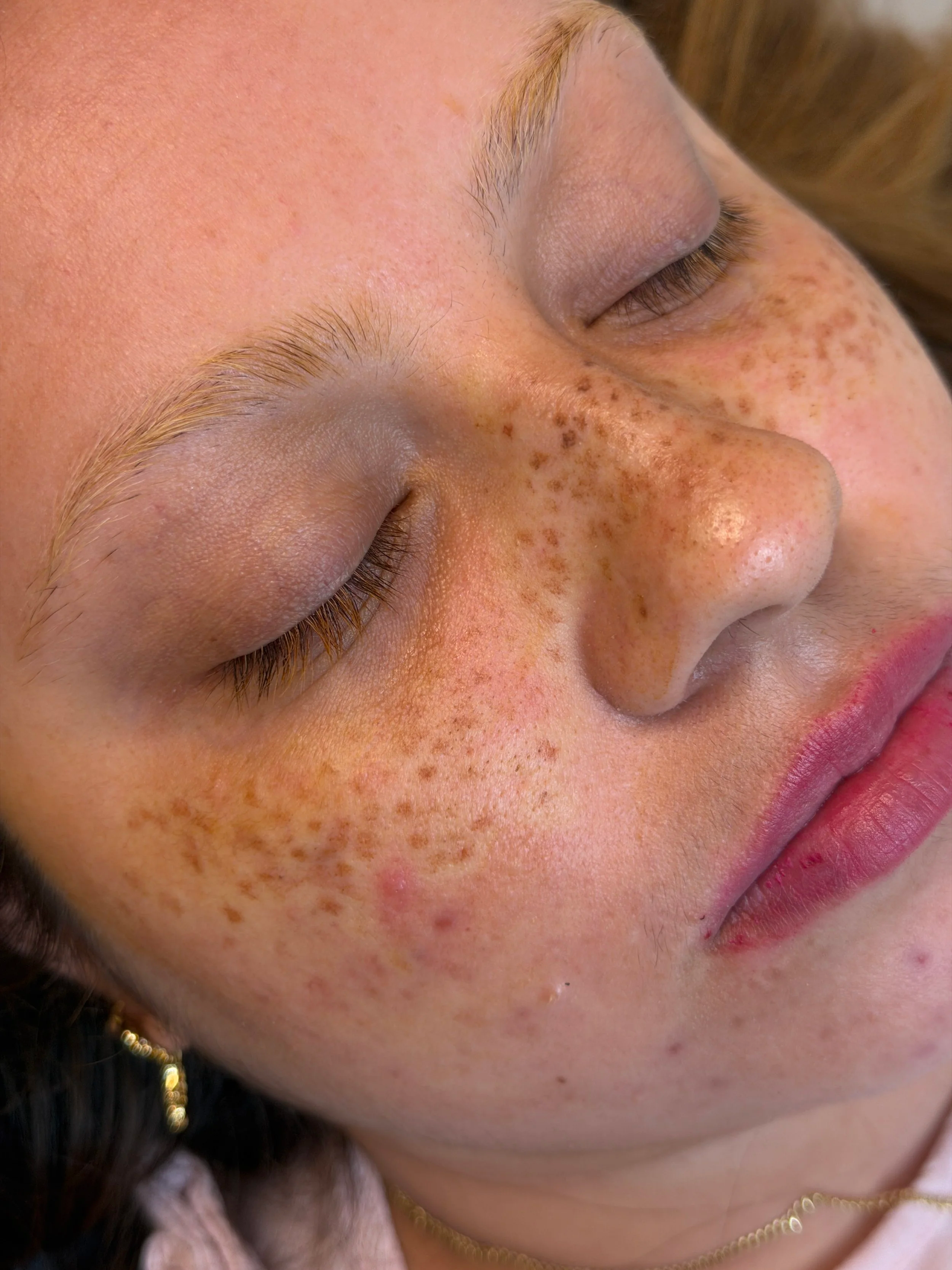 Freckles & Beauty Marks