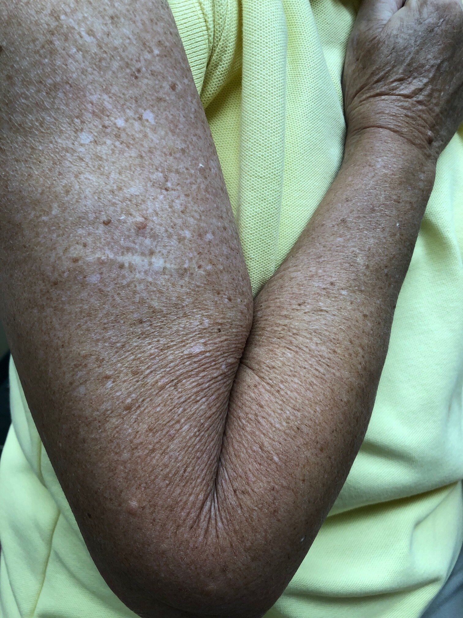 Skin Cancer Scar